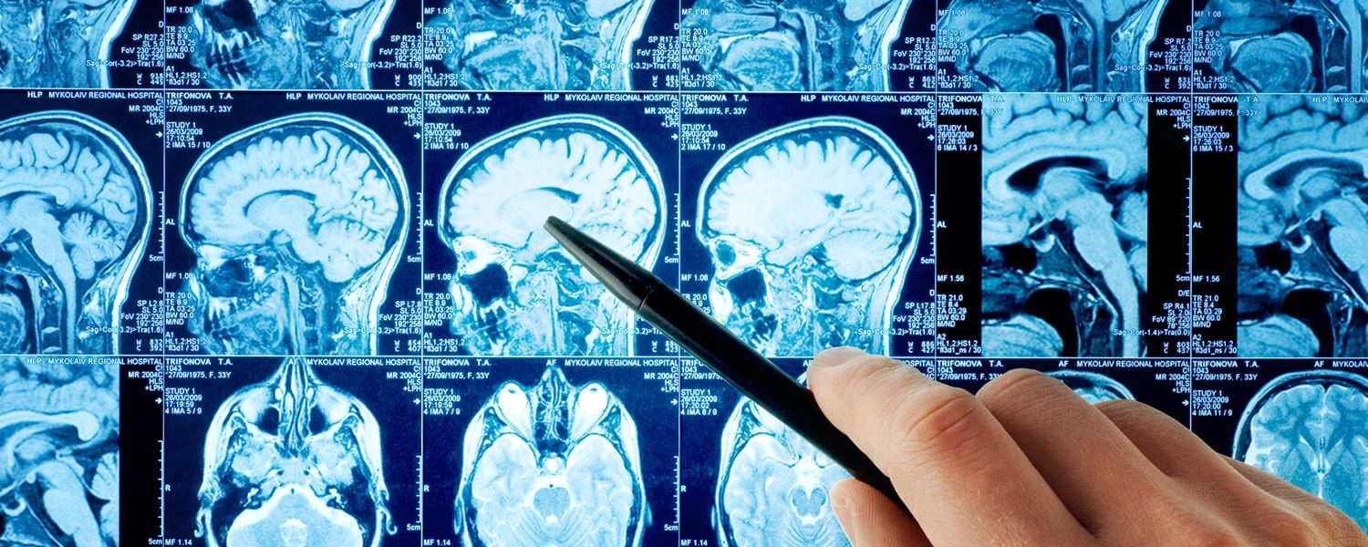 San Francisco Brain Injury Lawyer On New TBI Scan